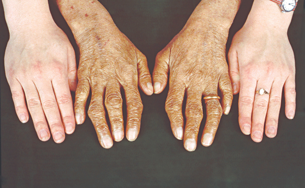 Thừa sắt - Hình ảnh minh họa